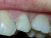 izbeljivanje-zuba-posle